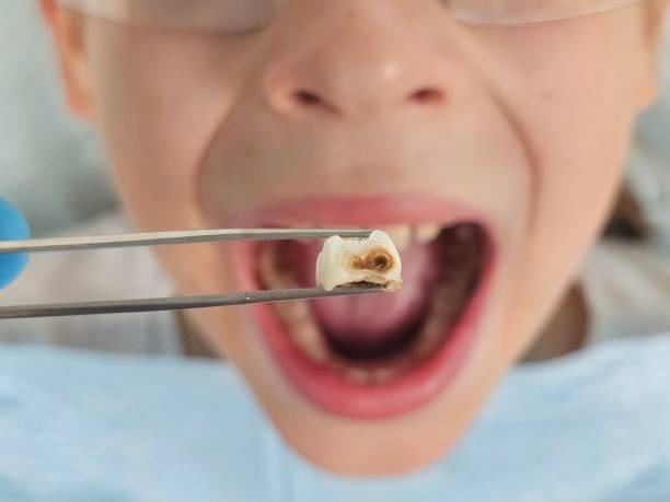 Best Emergency Tooth Extraction in St Francis, MN